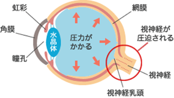 緑内障５.png