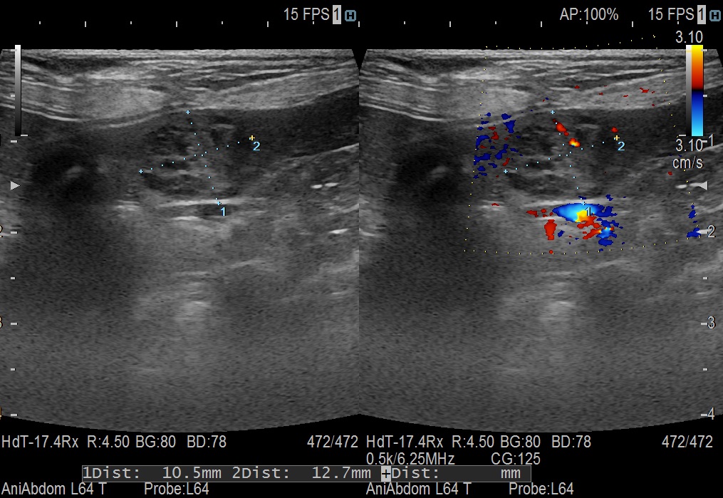 spleen mass1-2.jpg