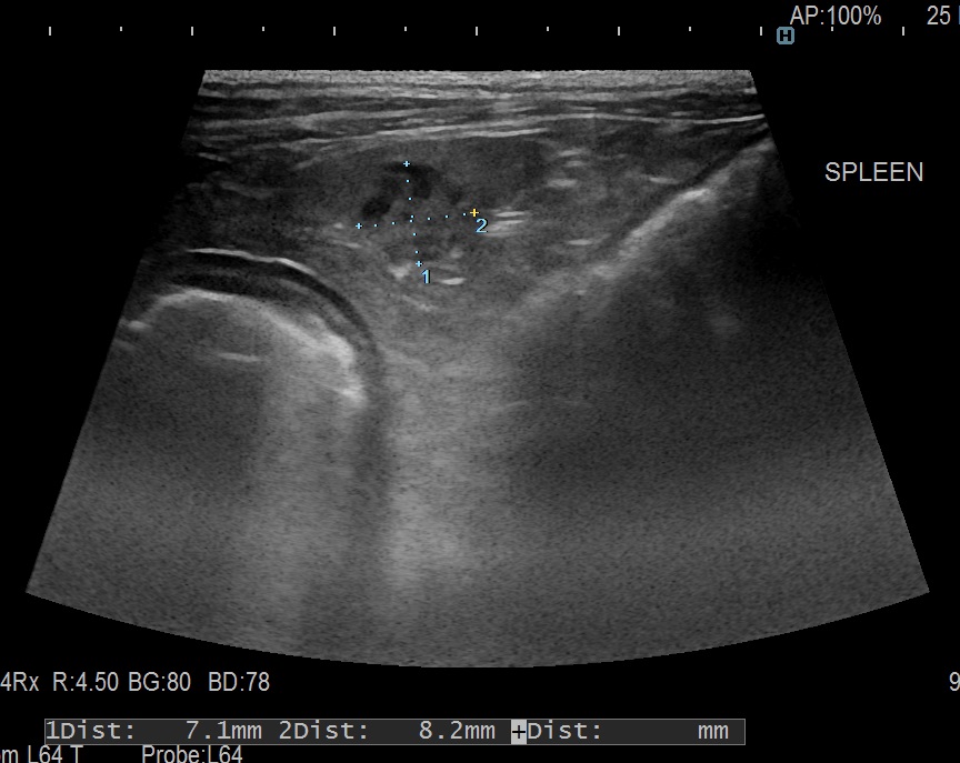 spleen mass2-2.jpg